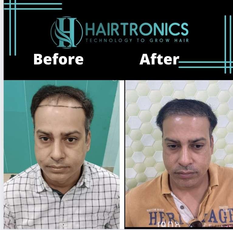 hairtronic clinic